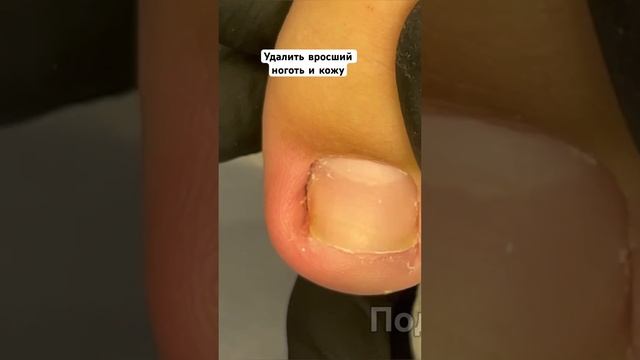 Шип ногтя, который колит #вросшиеногти #ingrowntoenail смотреть онлайн