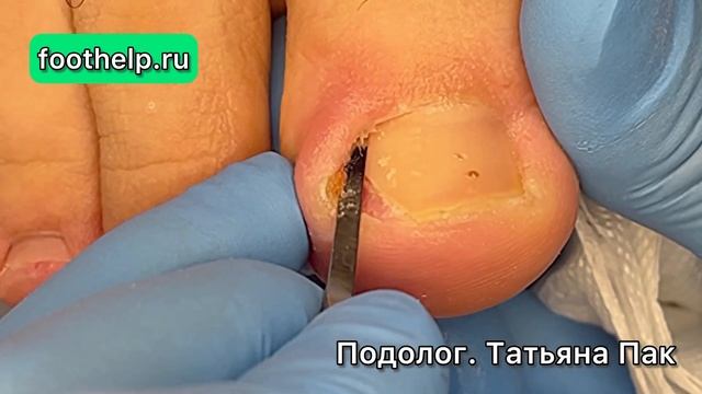 Форма вросшего ногтя | найти точку боли смотреть онлайн