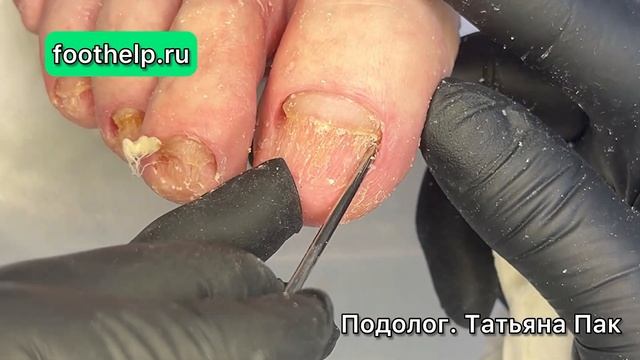 Зачистить инфицированные, пораженные ногти. Результат 100%. @podologmoscow смотреть онлайн