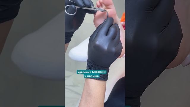 Спасти ножку малыша от сухой мозоли #удалениемозоли смотреть онлайн