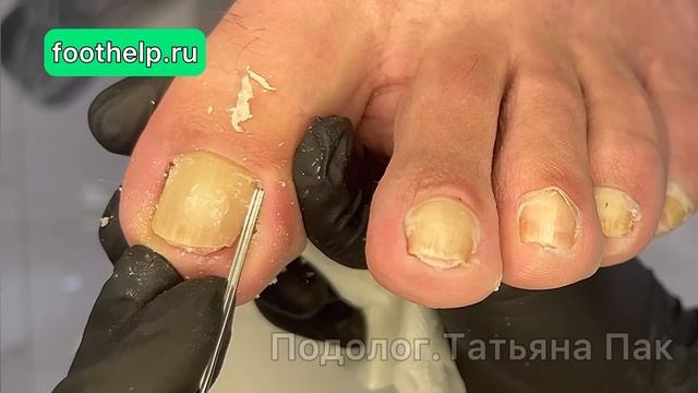 Кожные залежи в боковых пазухах ногтя | ноготь в трубочку #подологтатьянапак смотреть онлайн
