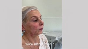 Отзыв нитевой лифтинг лица Аптос
