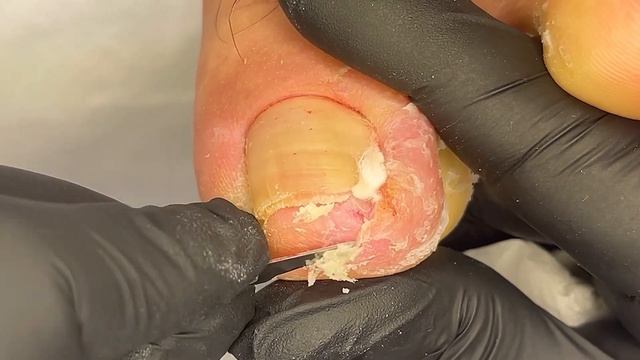 Подстриг ногти как смог | удаление щепки