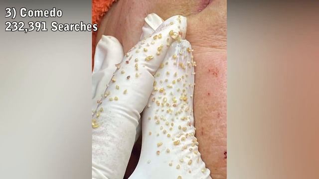 What Are Popaholics Searching The Most?! Top Ten Pimple Popping And Dermatology Search Terms