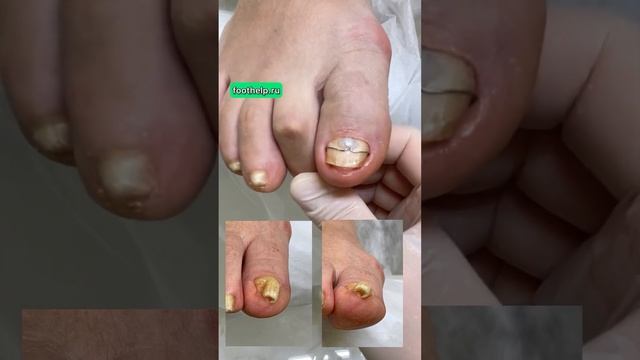 Раскрутить ногти- трубочки. Подология высшего уровня #подологтатьянапак #вросшийноготь смотреть онлайн