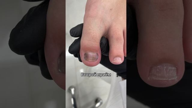 Запущенное состояние ногтей которым даю второй шанс #подологтатьянапак #вросшийноготь смотреть онлайн