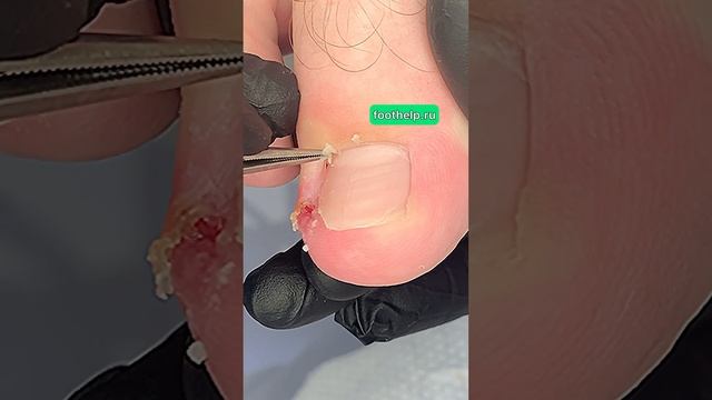 Найти точку Вашей боли и обезвредить #вросшийноготь #ingrown_toenail_surgery смотреть онлайн