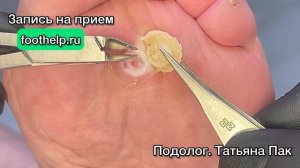 Разрастание болезненной фиброзной ткани у основания сухой мозоли