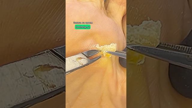Удалить мозоль с корнем #мозоли #подологмосква смотреть онлайн