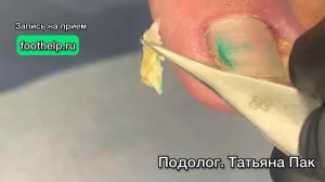 Вросшие боковые стенки ногтя глубоко в пазухи. Состояние гнойного воспаления