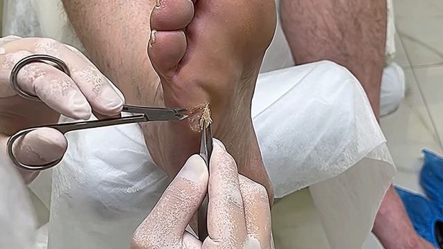 Обречен на постоянный рост | деформированная стопа | паллиатив у #подологтатьянапак #мозольудаление смотреть онлайн