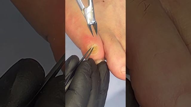 Удаление болезненной #мозоли на мизинце. @podologmoscow Запись на прием: foothelp.ru смотреть онлайн