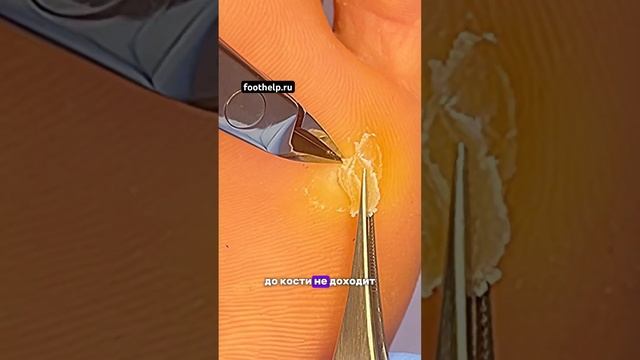 Удаление корневой мозоли @podologmoscow смотреть онлайн