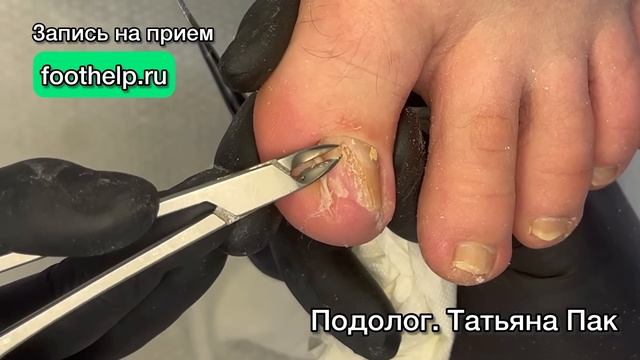Доврачебная подготовка пораженного ногтя к лечению. Чистка онихомикоза смотреть онлайн