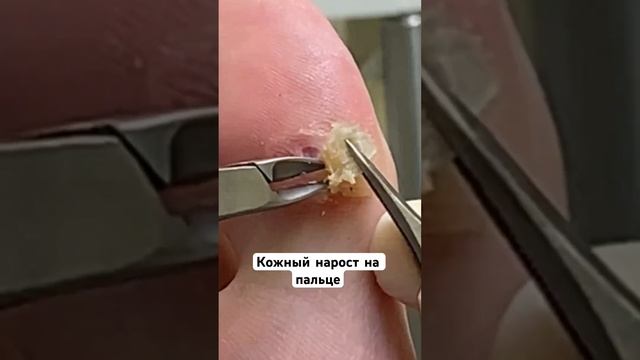 Твердый кожный нарост на большом пальце стопы. Причина образования, рекомендации по решению проблемы смотреть онлайн