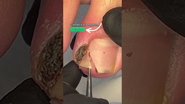 Больше видео на моем канале @podologmoscow #подологмосква смотреть онлайн