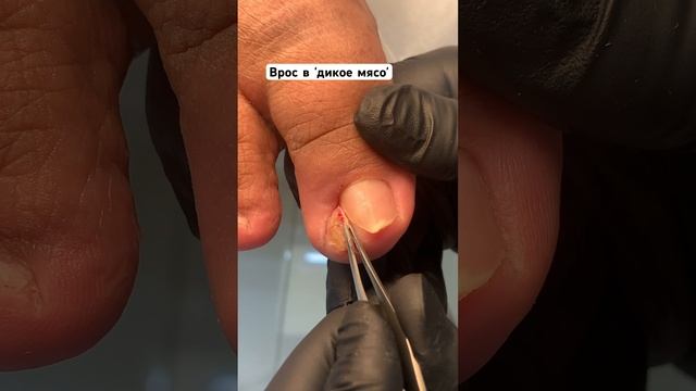 Вросший ноготь прорезал грануляцию бокового валика #вросшийноготь смотреть онлайн