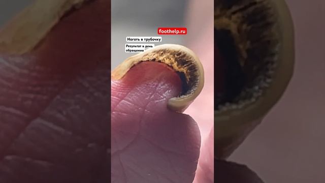 Исправление формы скрученного ногтя #подологтатьянапак смотреть онлайн