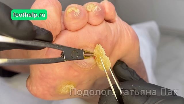 Новообразование на стопе в виде каменного нароста. Пациент 80+ | #подологтатьянапак смотреть онлайн