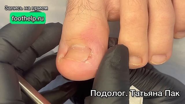 Выкрутить вросший сегмент ногтя застрявший где-то глубоко смотреть онлайн