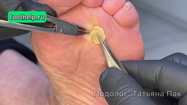 Последствие после радикальной хирургии. Корневая мозоль навсегда #подологтатьянапак смотреть онлайн