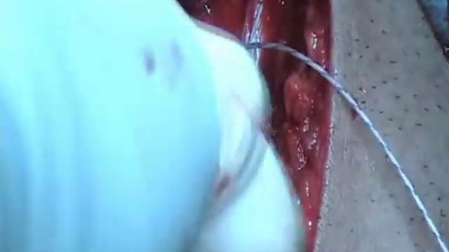 Shoulder Resurfacing Procedure JRGC Chennai Part-2 смотреть онлайн