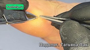 Неприметная мозоль оказалась с сюрпризом в виде многослойного кожного пресса