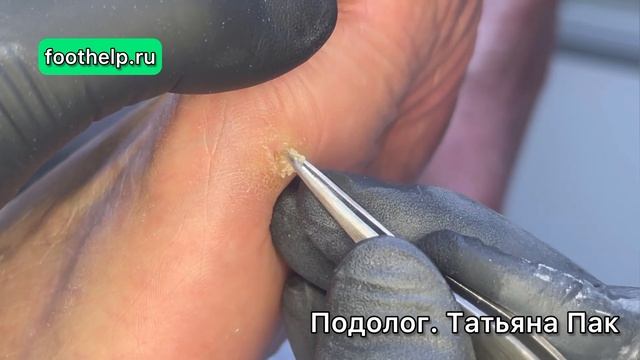 Конусная мозоль на плоской стопе смотреть онлайн