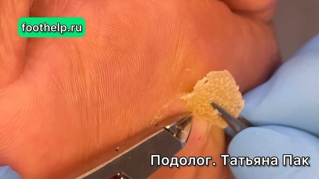 Болезненная мозоль простреливающая в палец #удалениемозоли смотреть онлайн