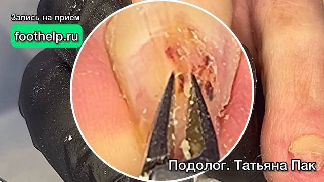 Капиллярное кровоизлияние под ногтем из-за давления смотреть онлайн