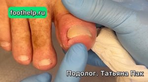 Ноготь пророс в глубине бокового валика