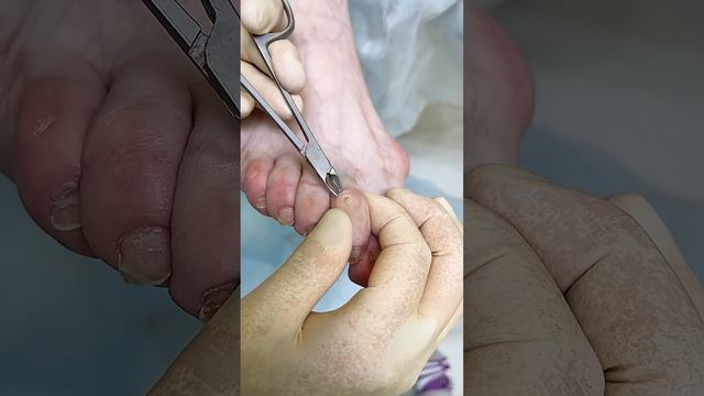 Сухие мозоли на косточках деформированных пальцев #мозоли смотреть онлайн