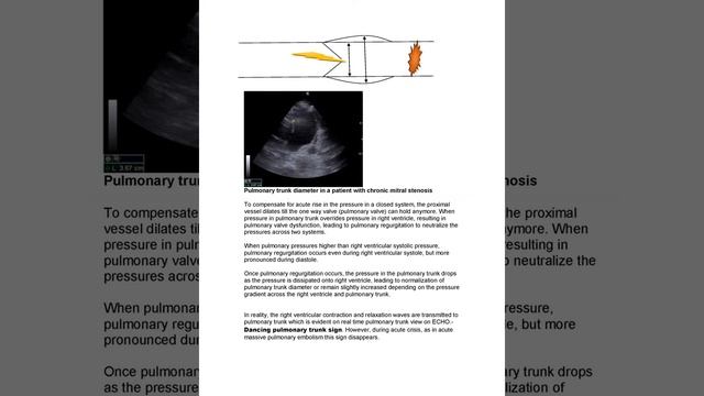 PULMONARY EMBOLISM смотреть онлайн