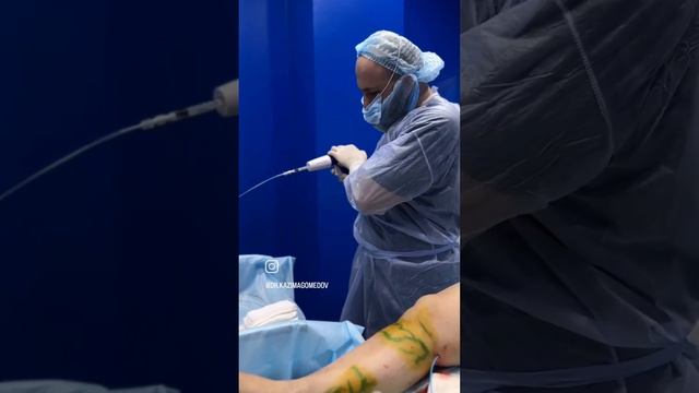 КЛЕЕВАЯ ОБЛИТЕРАЦИЯ! ВПЕРВЫЕ В ДАГЕСТАНЕ! #варикоз #тромбоз #флебологмосква смотреть онлайн