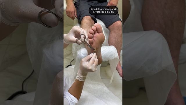 Могу, извлекаю, помогаю #подологтатьянапак #мозоли смотреть онлайн