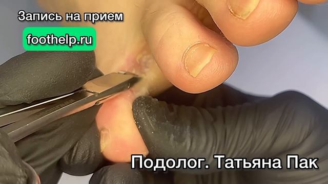 Межпальцевый нарост, мягкий и болезненный. смотреть онлайн