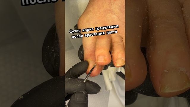 Сухая корка на грануляции в боковом валике #мозоли #подология смотреть онлайн