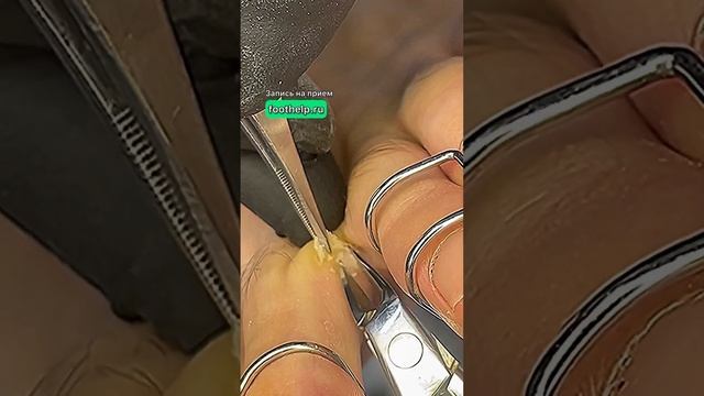 Межпальцевая болезненная мозоль #удалениемозоли смотреть онлайн