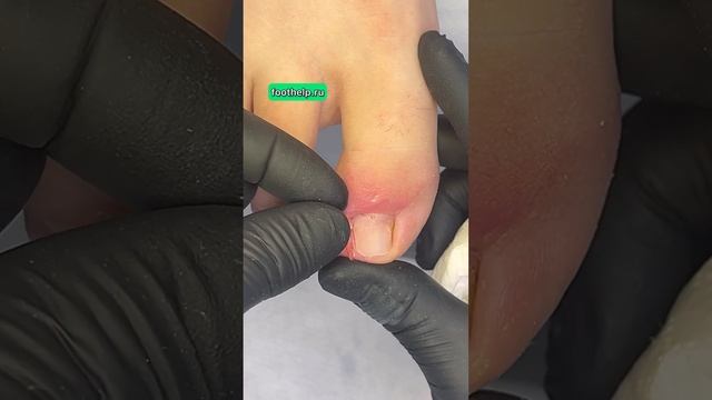 Острый шип вросшего ногтя. Запись на прием ➡️ foothelp.ru #подологмосква смотреть онлайн