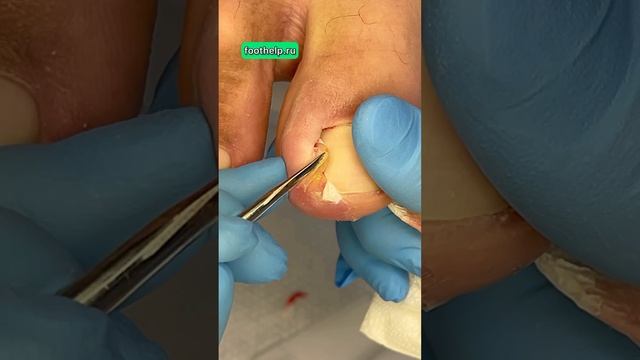 Опух палец от вросшего ногтя. ———#подологтатьянапак #вросшийноготь смотреть онлайн