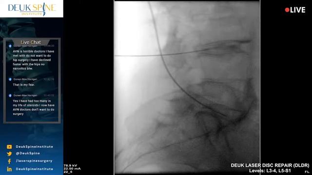 Deuk Laser Disc Repair at L4-5, L5-S1 of the Lumbar Spine смотреть онлайн