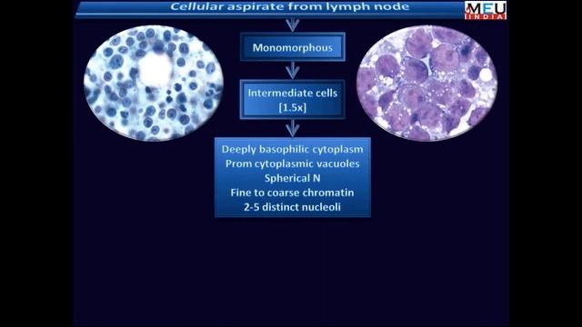 FNAC Lymph Node. смотреть онлайн