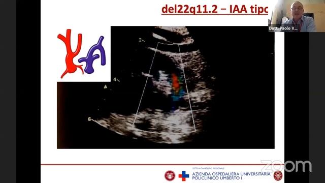 CARDIOPATIE CONGENITE E SINDROMI GENETICHE смотреть онлайн