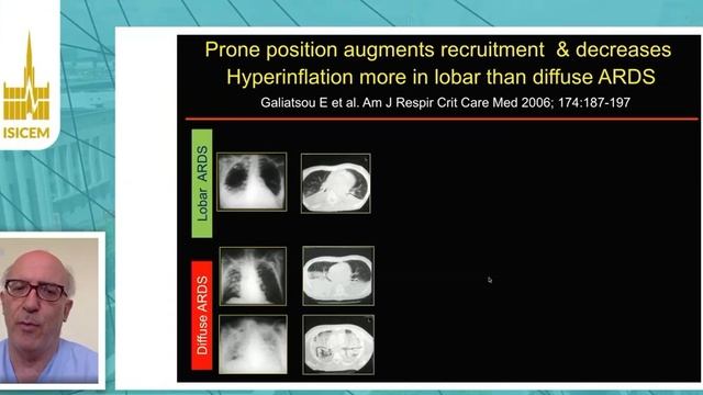 How to use PEEP in the prone position Paolo Pelosi (ISICEM 2020) смотреть онлайн