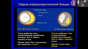 Острый инфаркт миокарда  Часть 1