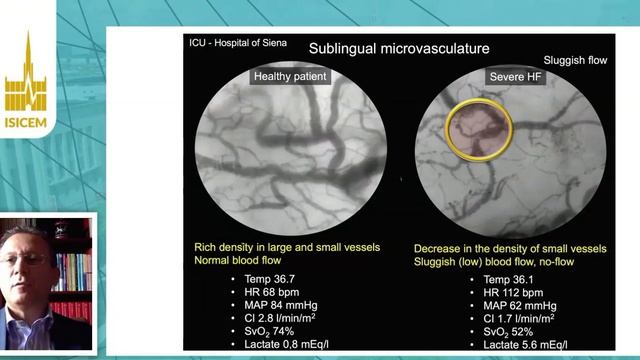Cardiogenic shock assistance and tissue perfusion Sabino  Scolletta (ISICEM 2020)