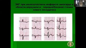 Острый инфаркт миокарда  Часть 2