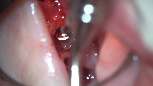 Internal Sinus lift versa burrs смотреть онлайн