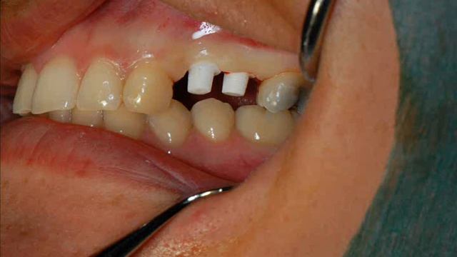 CeraRoot Zirconia Dental Implant Surgery (2 upper bicuspids) смотреть онлайн