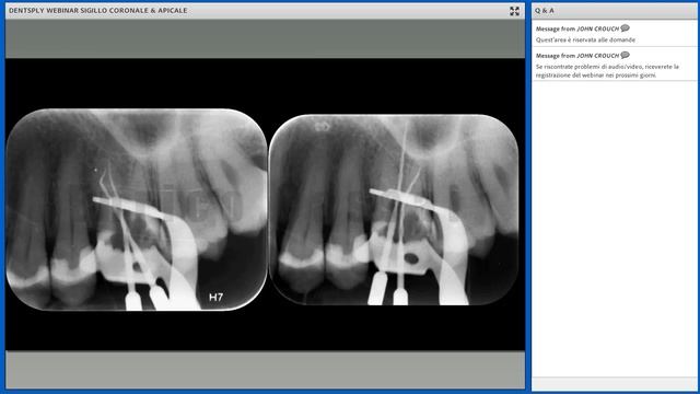 Il sigillo endodontico e il sigillo coronale смотреть онлайн